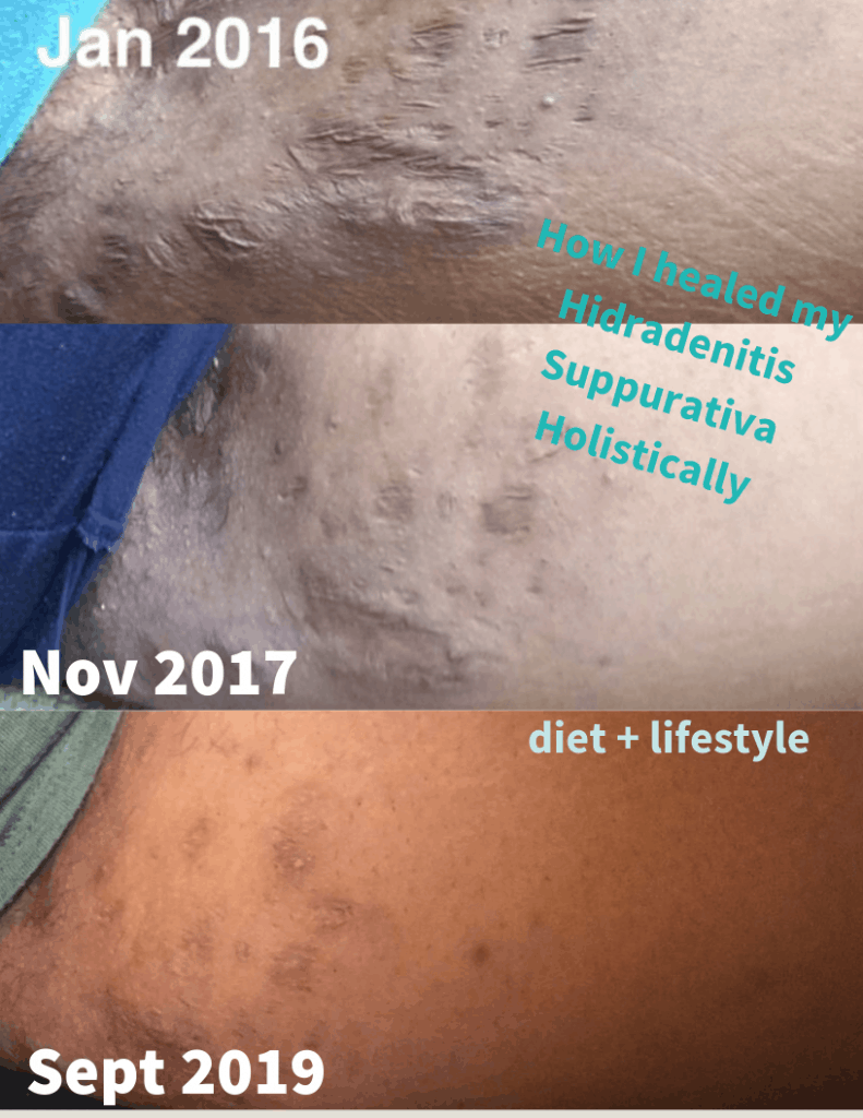 My Hidradenitis Suppurativa Diet & How AIP Changed My Life