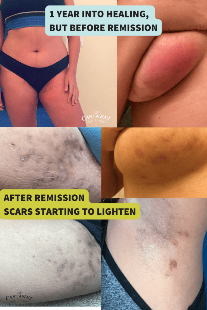 A BODY WITH HIDRADENITIS SUPPURATIVA ON GROIN, BREAST AND UNDER ARM AND THEN AFTER HEALED WITH SCARS
