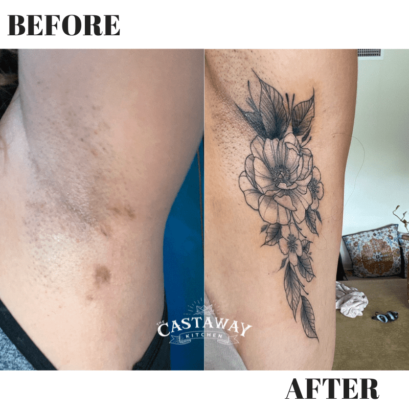 ARM PIT WITH HIDRADENTITIS SUPPURATIVA SCARS AND THEN AFTER WITH A TATTOO OVER THE SCARS